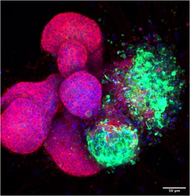 Normal (in red) and tumour (in green) mammary epithelial cells grown in 3D organoid culture in the lab 